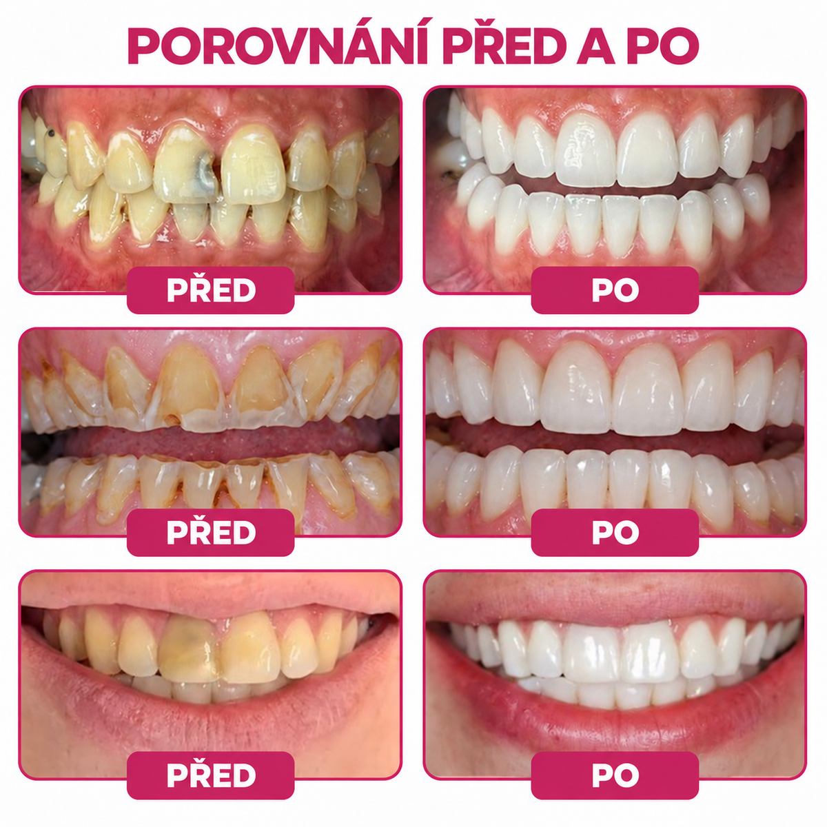 Keyess® DenPerm🎉🧣🧣 — Gel pro péči o zubní sklovinu při kazech, citlivých zubech a oslabené sklovině