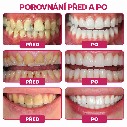 Keyess® DenPerm🎉🧣🧣 — Gel pro péči o zubní sklovinu při kazech, citlivých zubech a oslabené sklovině