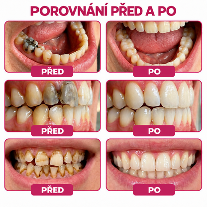 Keyess® DenPerm🎉🧣🧣 — Gel pro péči o zubní sklovinu při kazech, citlivých zubech a oslabené sklovině
