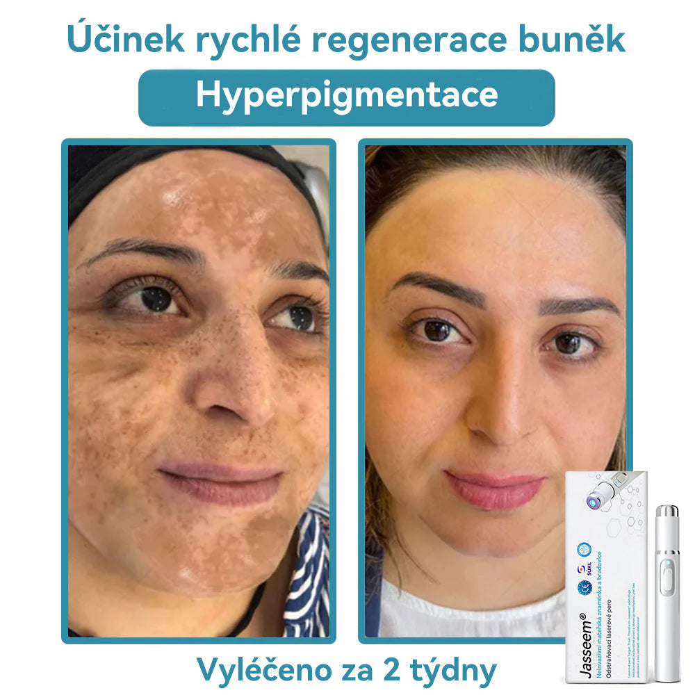 𝐉𝐚𝐬𝐬𝐞𝐞𝐦® Laserové pero lékařské kvality 💕 (Poháněno technologií CO₂ laseru – účinně odstraňuje znaménka, bradavice, kožní výrůstky, pigmentové skvrny a další nedokonalosti pleti) 🔥