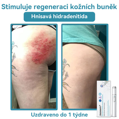 𝐉𝐚𝐬𝐬𝐞𝐞𝐦® Laserové pero lékařské kvality 💕 (Poháněno technologií CO₂ laseru – účinně odstraňuje znaménka, bradavice, kožní výrůstky, pigmentové skvrny a další nedokonalosti pleti) 🔥