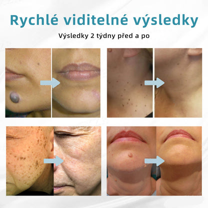 𝐉𝐚𝐬𝐬𝐞𝐞𝐦® Laserové pero lékařské kvality 💕 (Poháněno technologií CO₂ laseru – účinně odstraňuje znaménka, bradavice, kožní výrůstky, pigmentové skvrny a další nedokonalosti pleti) 🔥