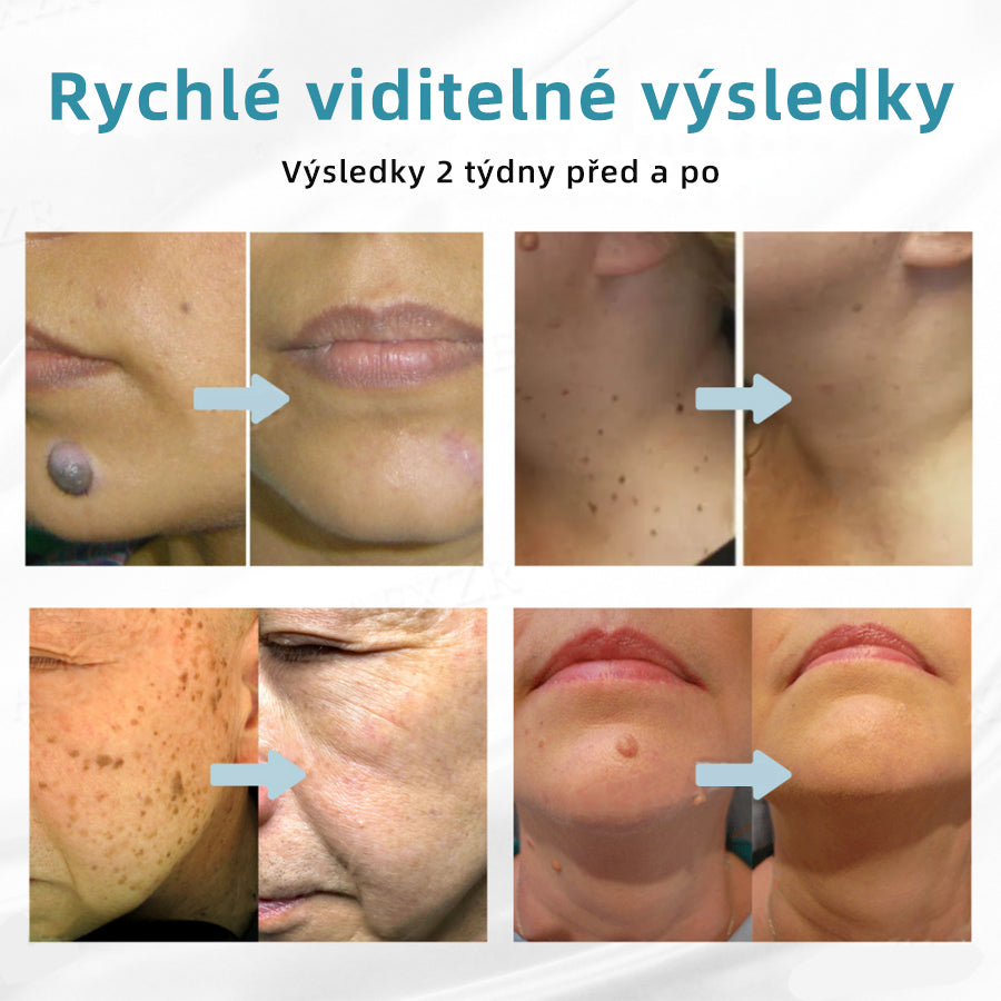 [✅Viditelné výsledky již za 7 dní] 𝐉𝐚𝐬𝐬𝐞𝐞𝐦® 🔥🔥 𝐍𝐞𝐢𝐧𝐯𝐚𝐳𝐢𝐯𝐧í 𝐦𝐚𝐭𝐞ř𝐬𝐤á 𝐳𝐧𝐚𝐦é𝐧𝐤𝐚 𝐚 𝐛𝐫𝐚𝐝𝐚𝐯𝐢𝐜𝐞 𝐎𝐝𝐬𝐭𝐫𝐚ň𝐨𝐯𝐚𝐜í 𝐥𝐚𝐬𝐞𝐫𝐨𝐯é 𝐩𝐞𝐫𝐨 🎉Doporučení dermatologové v České republice
