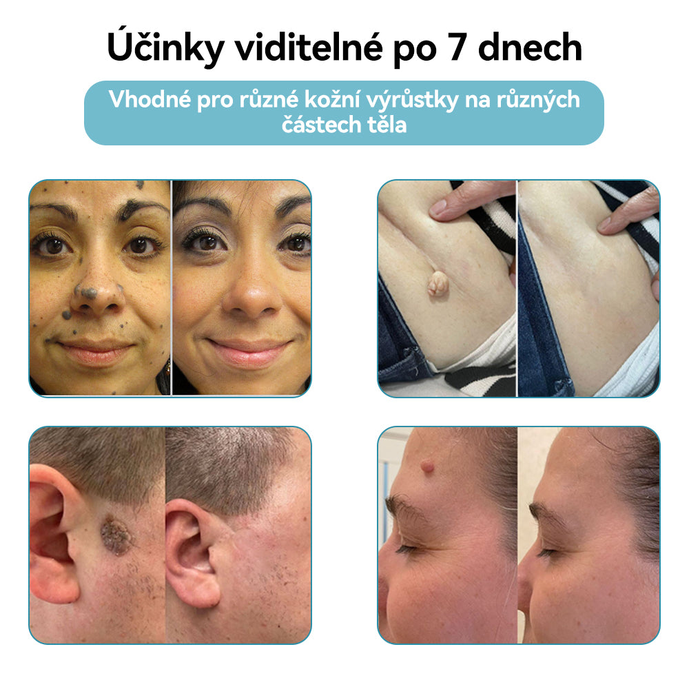 𝐉𝐚𝐬𝐬𝐞𝐞𝐦® Laserové pero lékařské kvality 💕 (Poháněno technologií CO₂ laseru – účinně odstraňuje znaménka, bradavice, kožní výrůstky, pigmentové skvrny a další nedokonalosti pleti) 🔥