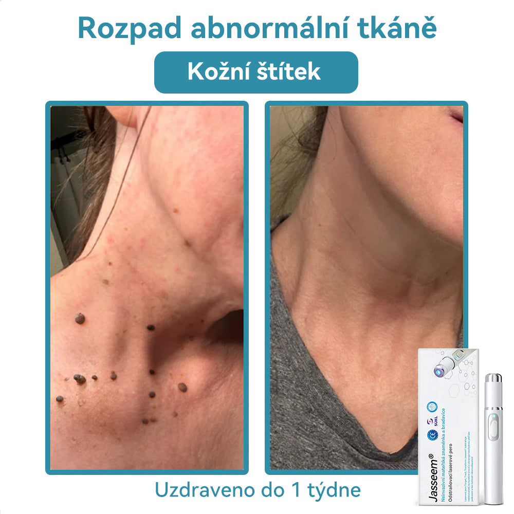 𝐉𝐚𝐬𝐬𝐞𝐞𝐦® Laserové pero lékařské kvality 💕 (Poháněno technologií CO₂ laseru – účinně odstraňuje znaménka, bradavice, kožní výrůstky, pigmentové skvrny a další nedokonalosti pleti) 🔥