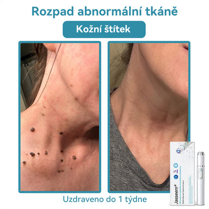 𝐉𝐚𝐬𝐬𝐞𝐞𝐦® Laserové pero lékařské kvality 💕 (Poháněno technologií CO₂ laseru – účinně odstraňuje znaménka, bradavice, kožní výrůstky, pigmentové skvrny a další nedokonalosti pleti) 🔥